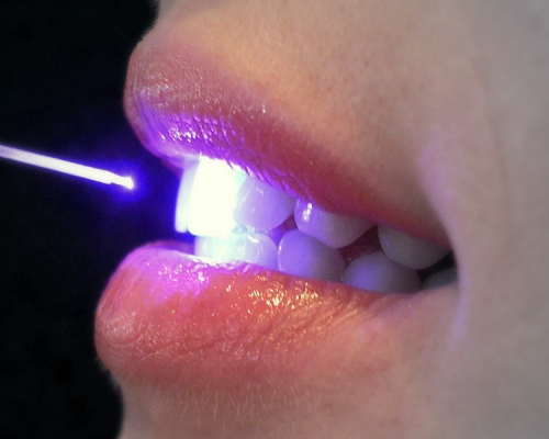 La verità sul LASER dal dentista